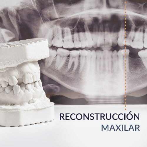 Tratamientos para la reconstrucción maxilar ós