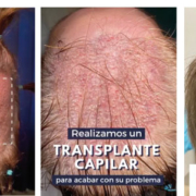 Zona donante parcialmente rapada para un injerto capilar en mujer