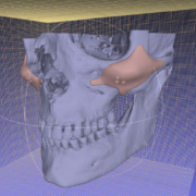 Implantes de pómulos en Madrid