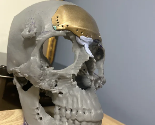 Cráneo hundido en adultos