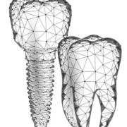 Implantes monofásicos precios Implantes monofásicos precio