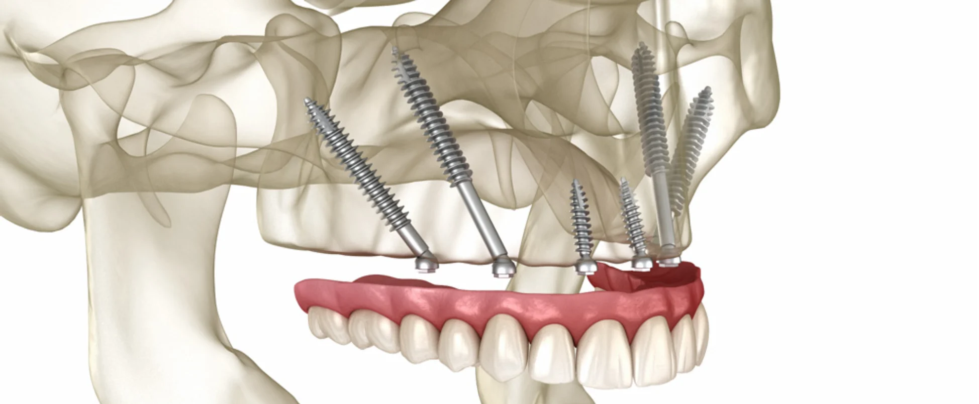 Clínica Implantes cigomáticos en Madrid
