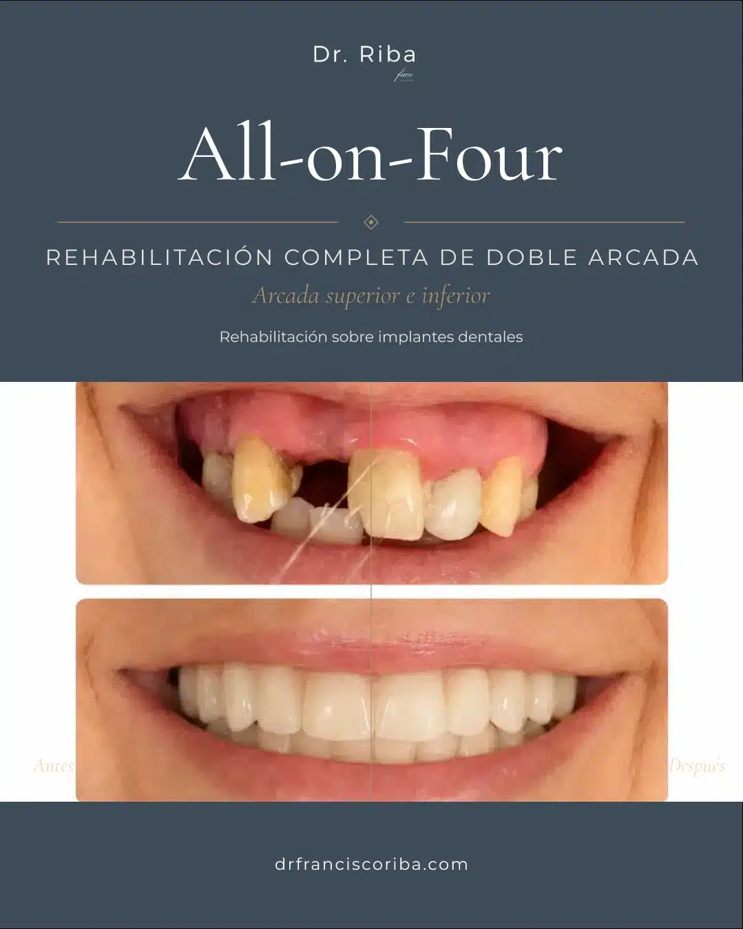 All on Four en doble arcada, segundo caso | Face Clinic Antes y después de otro All on Four en las dos arcadas, caso del Dr. Riba