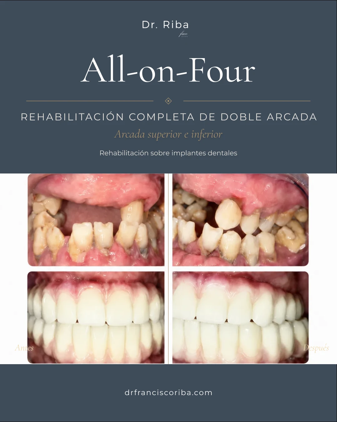 All on Four en doble arcada | Face Clinic Antes y después de un All on Four en las dos arcadas, caso del Dr. Riba