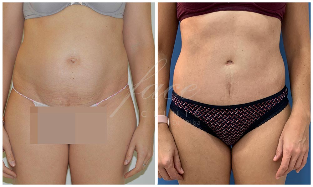 Antes y después de una abdominoplastia: proceso y postoperatorio