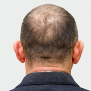 Alopecia androgénica en hombres
