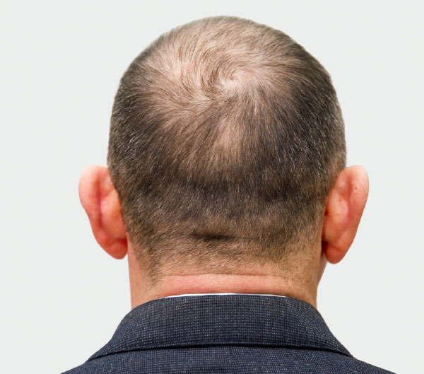 Alopecia androgénica en hombres
