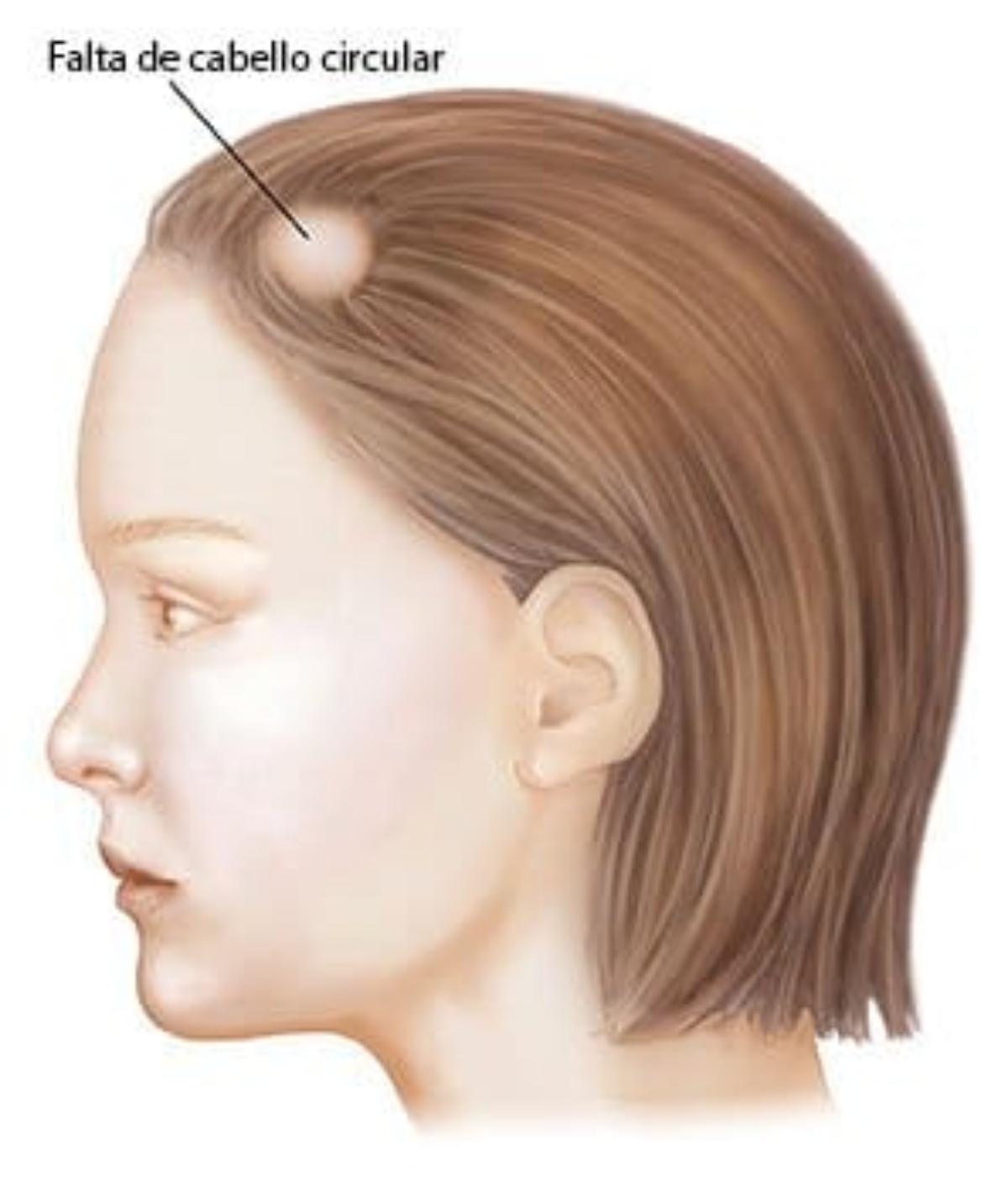 Desarrollar observación patrulla Alopecia Areata: Causas, tratamiento y mujeres - Face Clinic