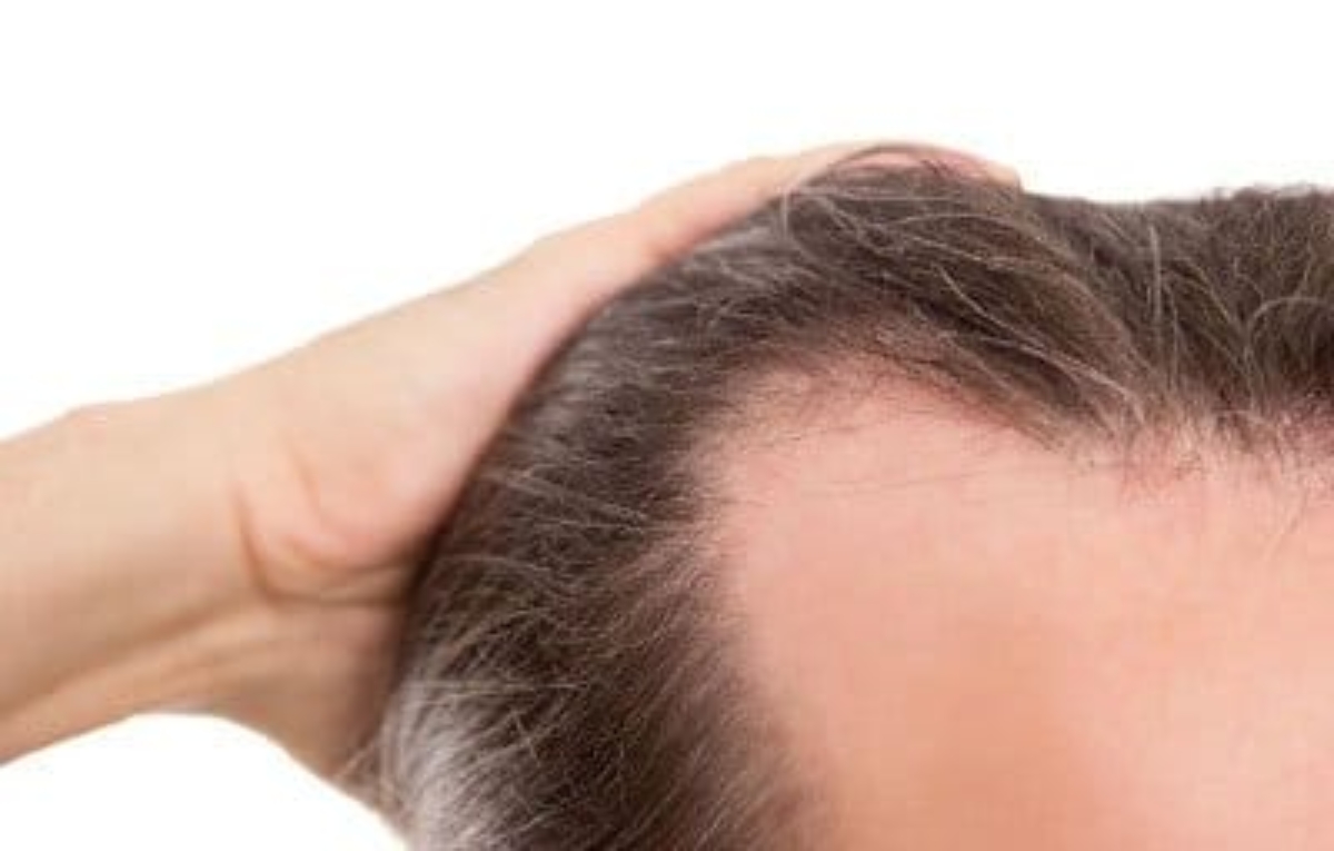 Alopecia por estrés alopecia nerviosa - Face