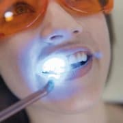 Blanqueamiento Dental en clínica