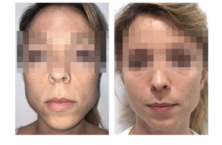 Botox Bruxismo antes y después