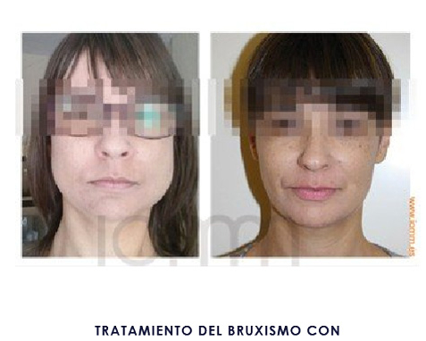 Botox Bruxismo - Caso 1