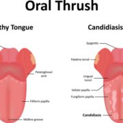 Candidiasis Oral tratamiento