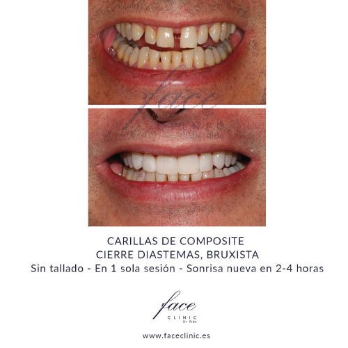 Carillas dentales antes y despues - Caso 1
