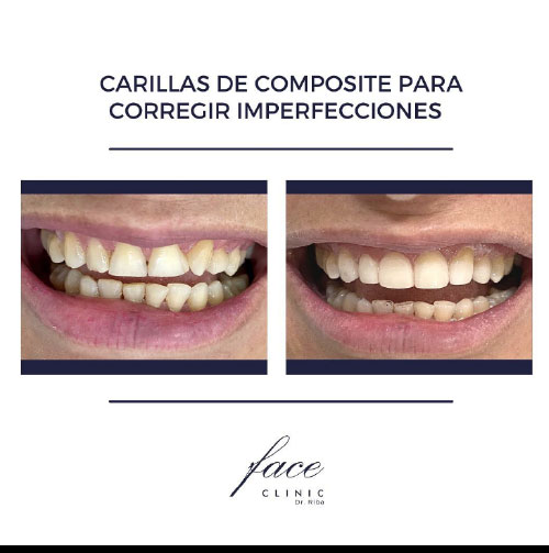 Carillas dentales antes y después - caso 6