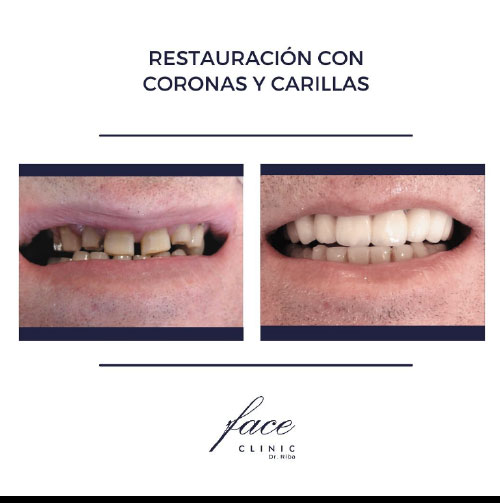 Carillas dentales antes y después - caso 7