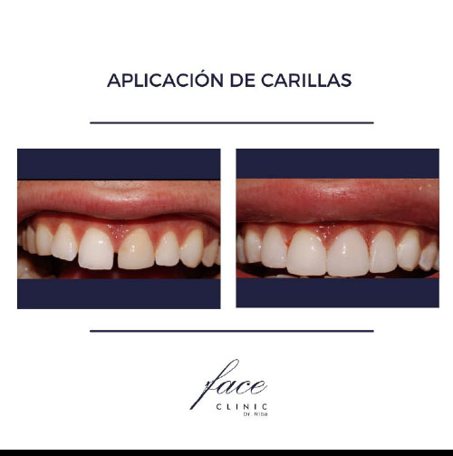 Carillas dentales antes y después - caso 9