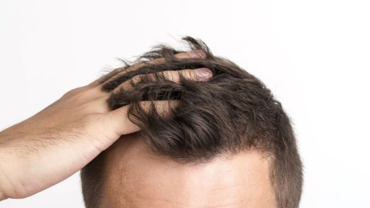 Causas de la caída del pelo en hombres y mujeres - Clinic