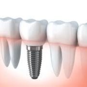 clinica de implantes dentales en Pozuelo