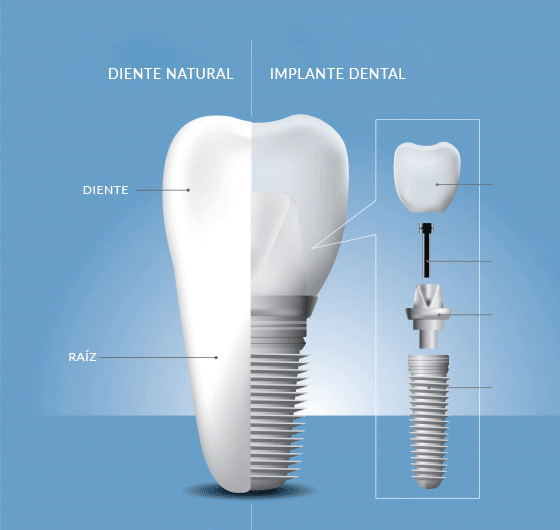 Clinica implantes dentales