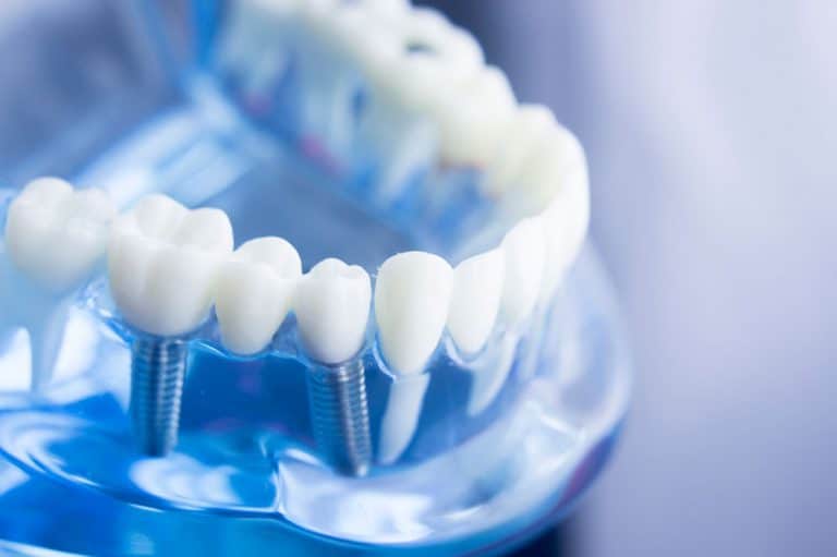 implantes dentales en Huelva