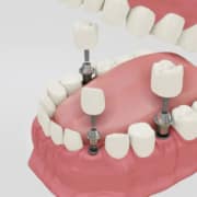 Como limpiar los implantes dentales