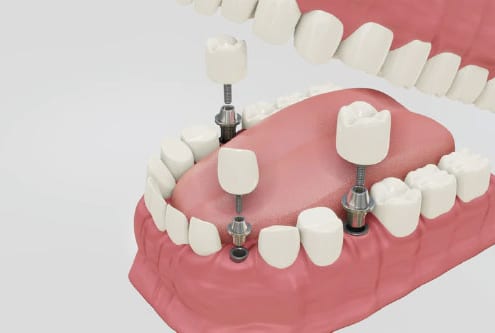 Como limpiar los implantes dentales