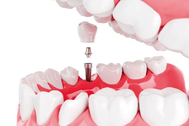 ¿Cómo se coloca un implante dental?