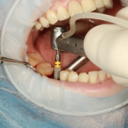 ¿Como Se Colocan Los Implantes Dentales?