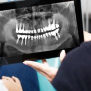 Complicaciones de los implantes dentales y su tratamiento