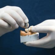 rehabilitacion de coronas sobre implantes en Madrid