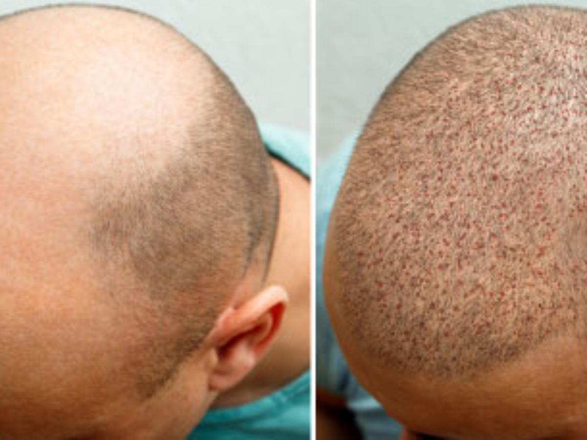 maestría para agregar prueba Costras tras un injerto de pelo - Face Clinic