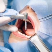 Cuanto tiepo se tarda en colocar un implante dental