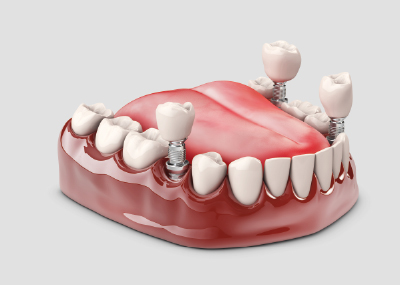 ¿Cuántos implantes dentales se pueden poner en un día? 