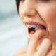 Elásticos intermaxilares en ortodoncia