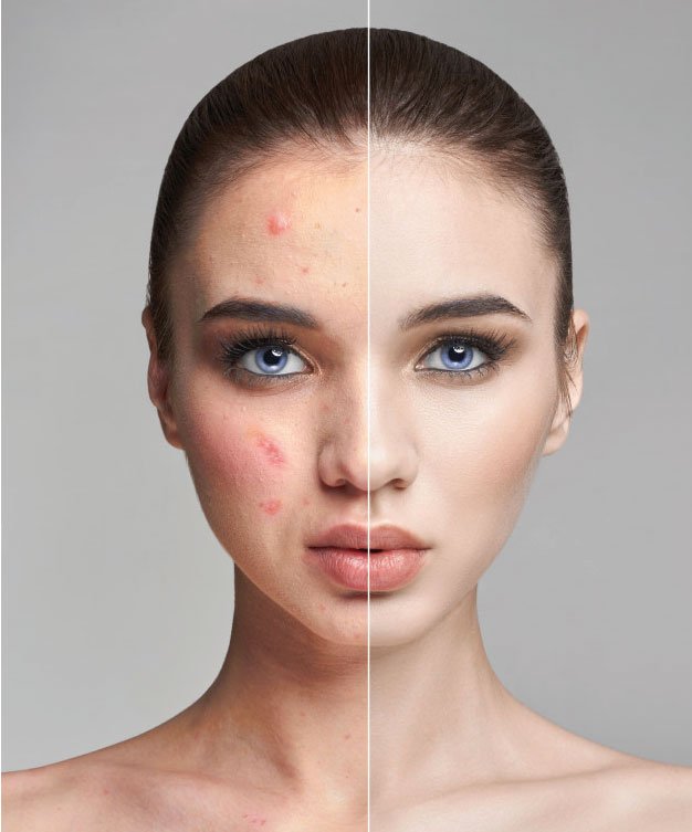 frutas Mayor Discriminación Quitar y eliminar marcas de acne - Face Clinic