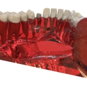 Como afectan los implantes dentales en nuestra salud