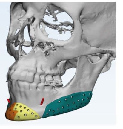 protesis mandibular