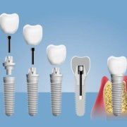 Osteointegración en implantes dentales