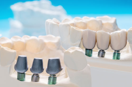 Implantes dentales de Carga Inmediata en Valladolid
