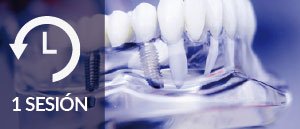 Implantes dentales en 1 sesión