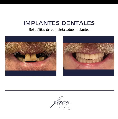 Implantes dentales antes y después - Caso 3