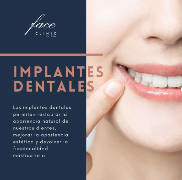 Implantes dentales beneficios