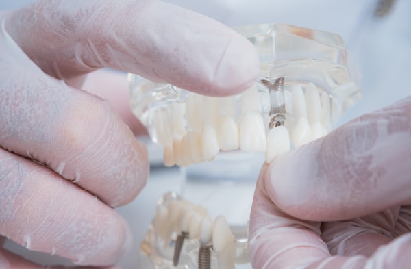 Implantes dentales con poco hueso Pozuelo y Aravaca