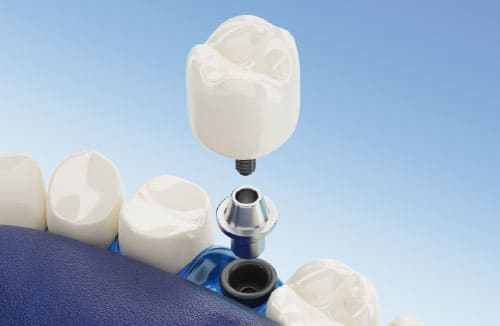 Implantes dentales en 2 fases
