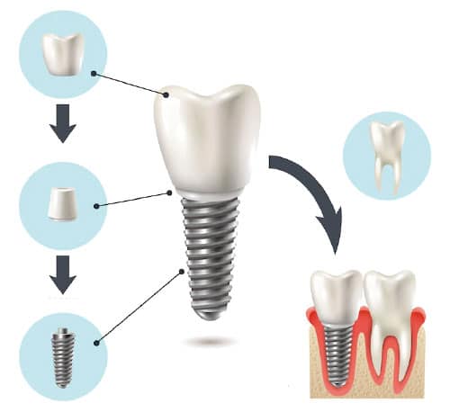 Implantes dentales endoóseos
