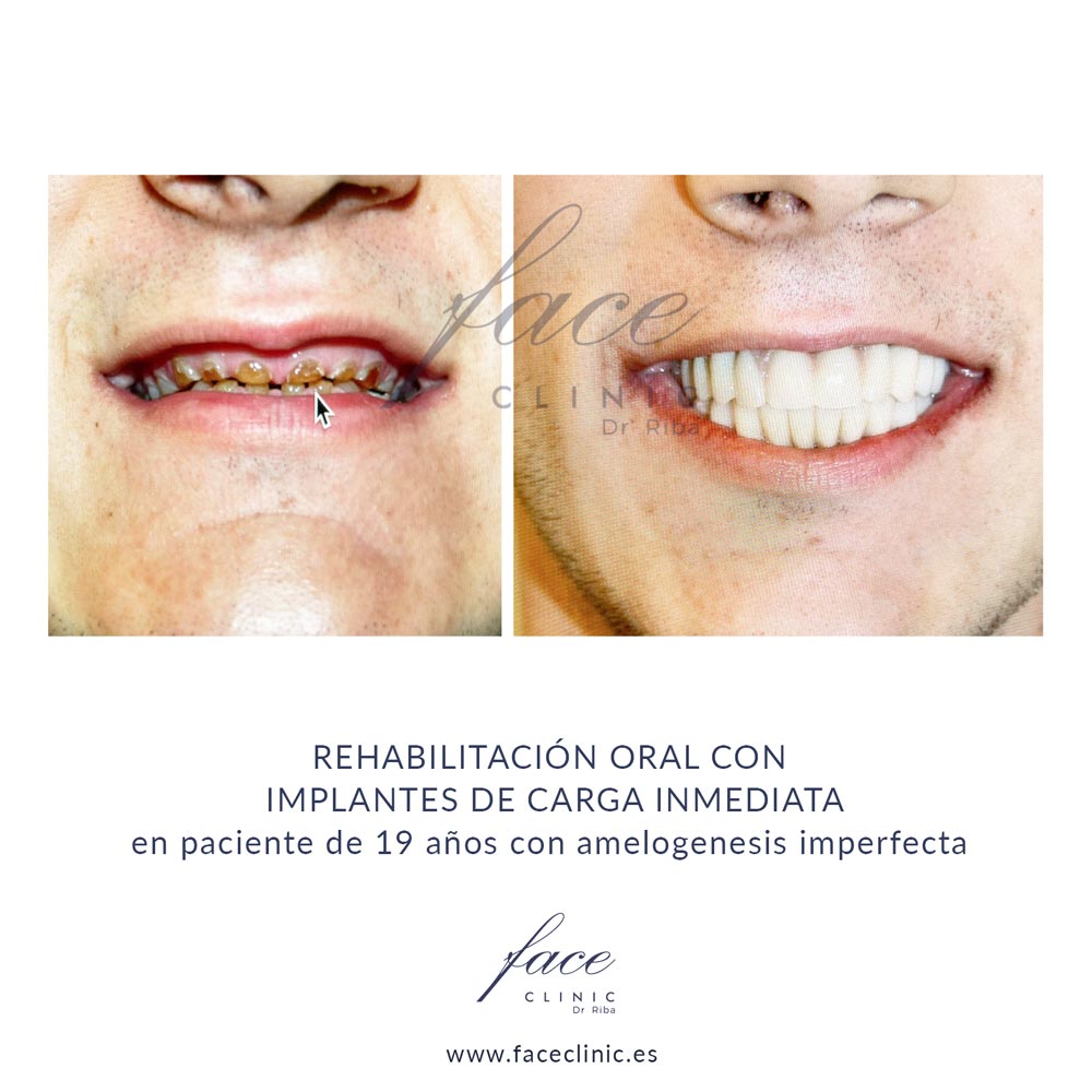 Implantes dentales en Huelva - Caso 1