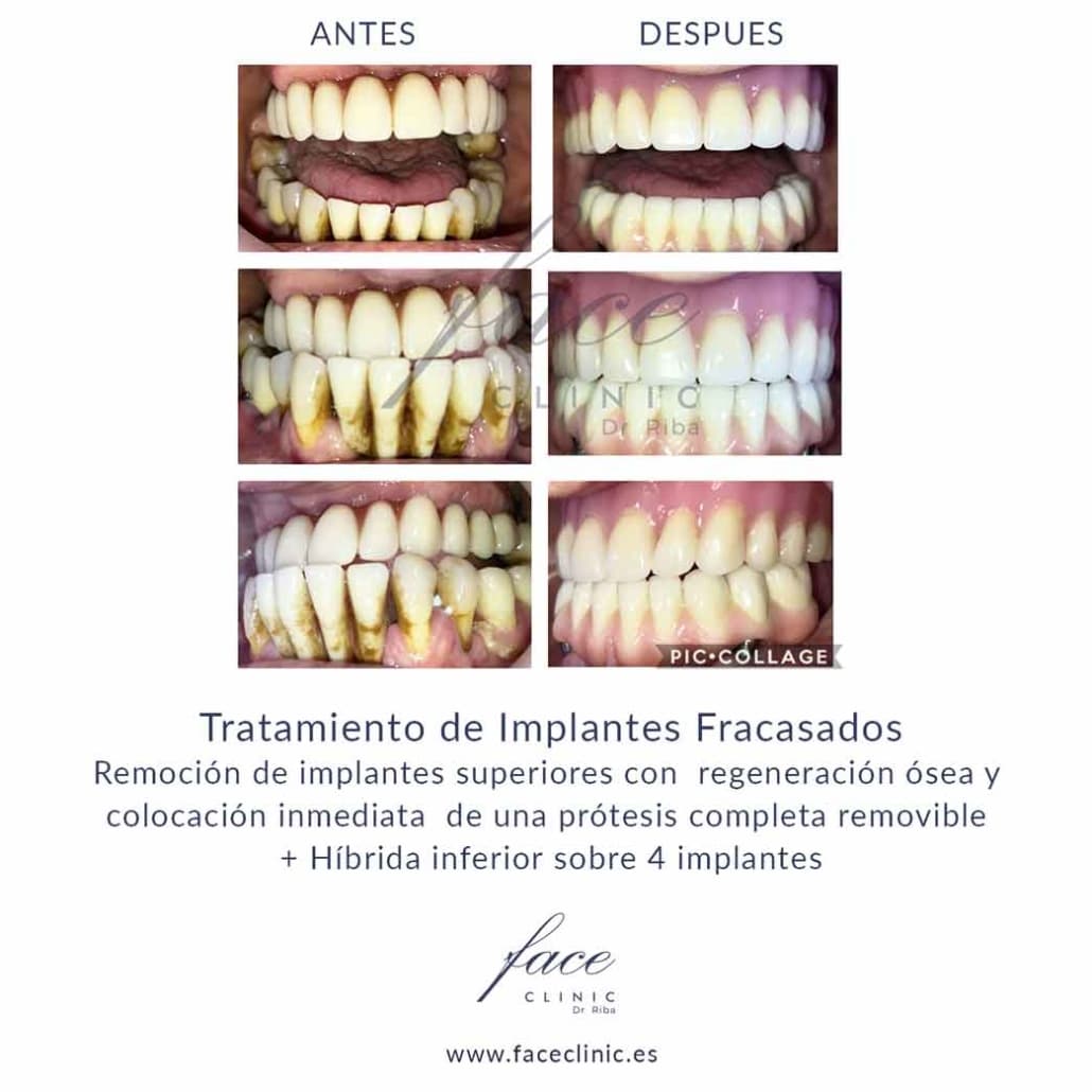 Implantes dentales en Huelva - Caso 2