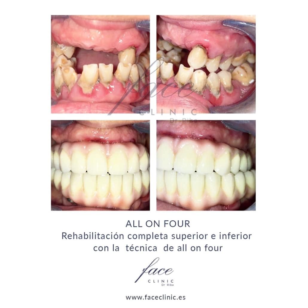 Implantes dentales sin hueso Salamanca - caso 1