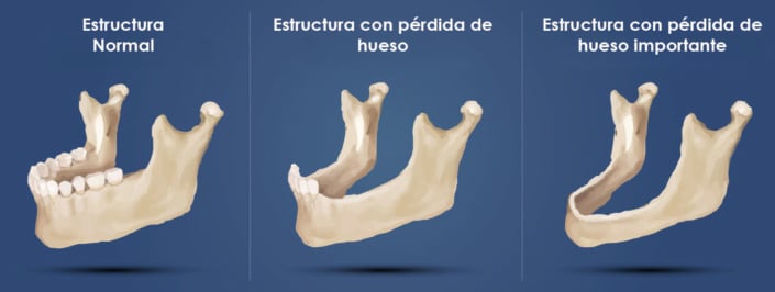 Implantes dentales con poco hueso en Huelva